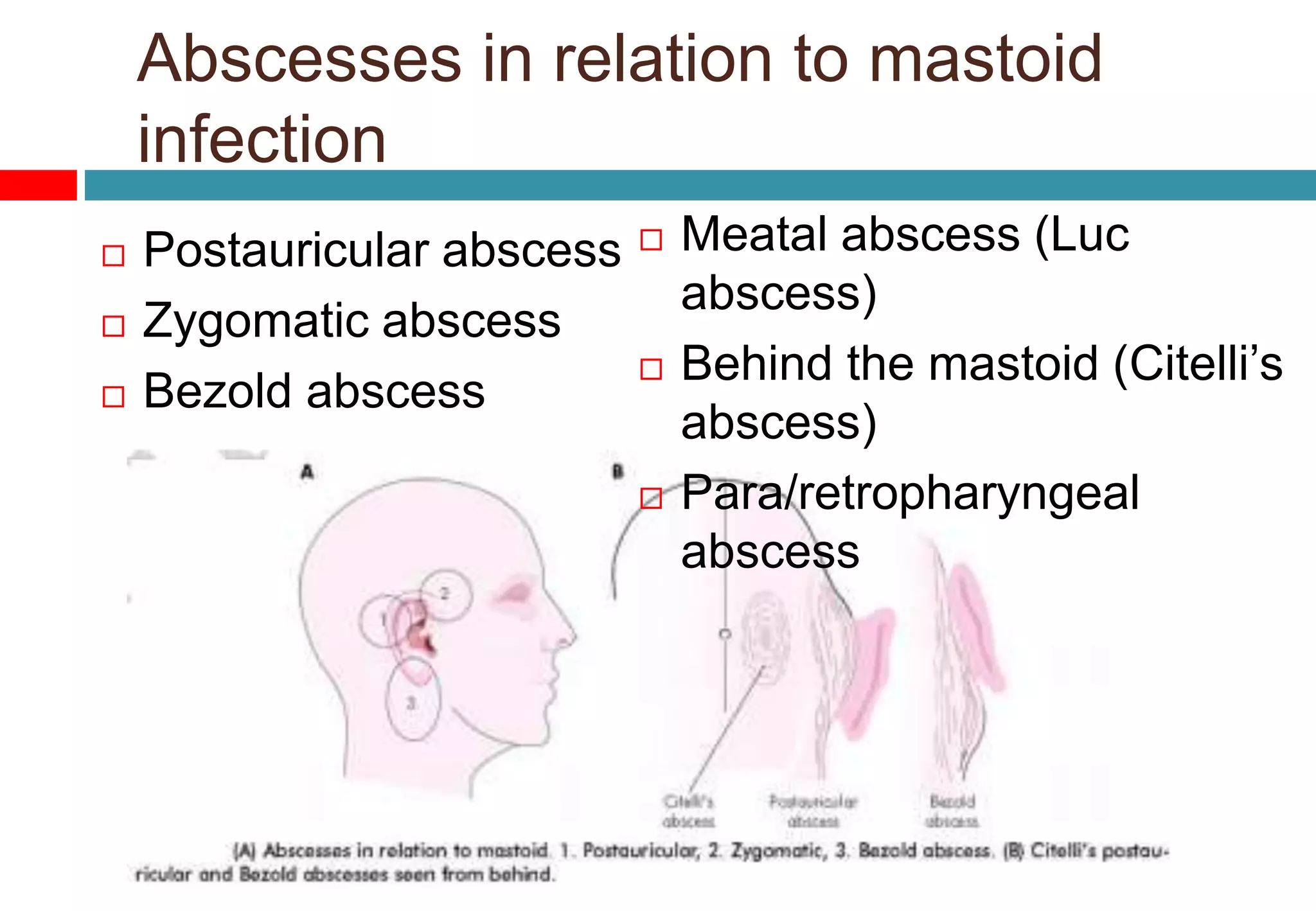 Abscesses in relation to mastoid
infection
 Postauricular abscess
 Zygomatic abscess
 Bezold abscess
 Meatal abscess (Luc
abscess)
 Behind the mastoid (Citelli’s
abscess)
 Para/retropharyngeal
abscess
 