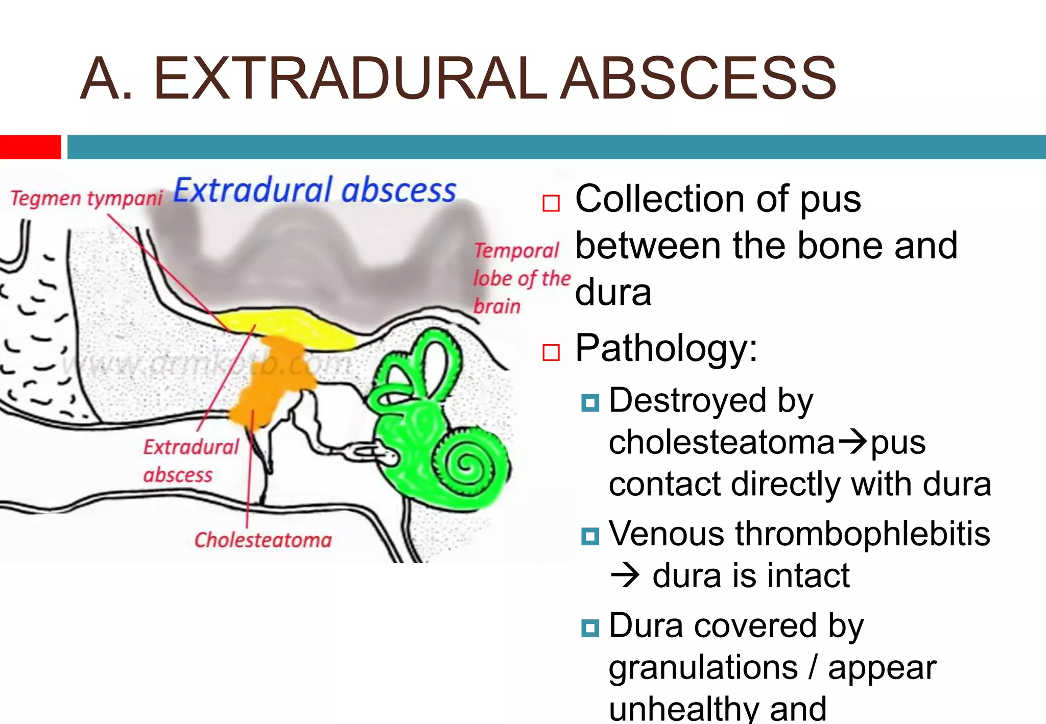 A. EXTRADURAL ABSCESS
 Collection of pus
between the bone and
dura
 Pathology:
 Destroyed by
cholesteatomapus
contact directly with dura
 Venous thrombophlebitis
 dura is intact
 Dura covered by
granulations / appear
unhealthy and
 