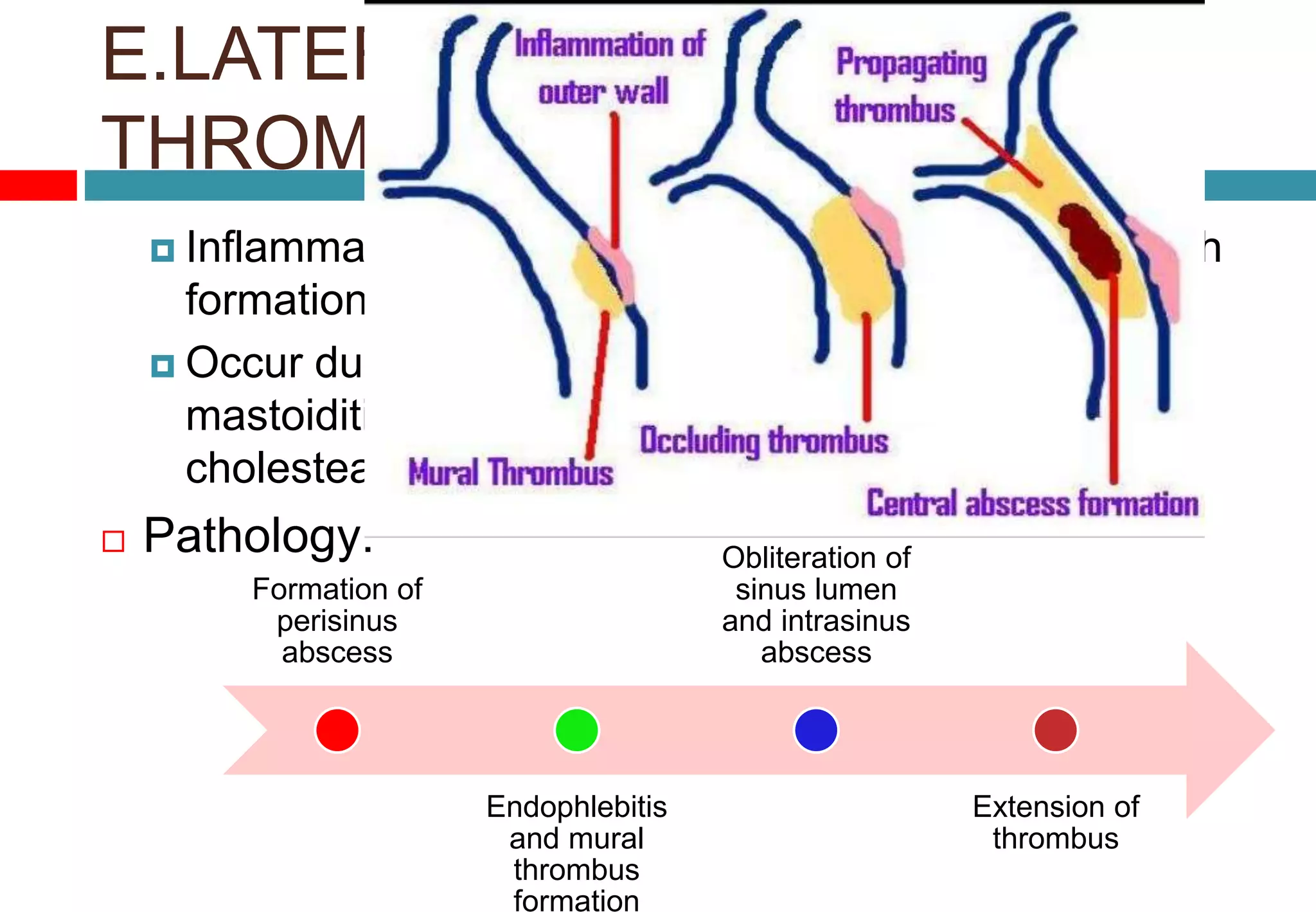 E.LATERAL SINUS
THROMBOPHLEBITIS
 Inflammation of inner wall of lateral venous sinus with
formation of intrasinus thrombus
 Occur due to acute coalescent mastoiditis, masked
mastoiditis, chronic suppuration of middle ear and
cholesteatoma
 Pathology:
Formation of
perisinus
abscess
Endophlebitis
and mural
thrombus
formation
Obliteration of
sinus lumen
and intrasinus
abscess
Extension of
thrombus
 