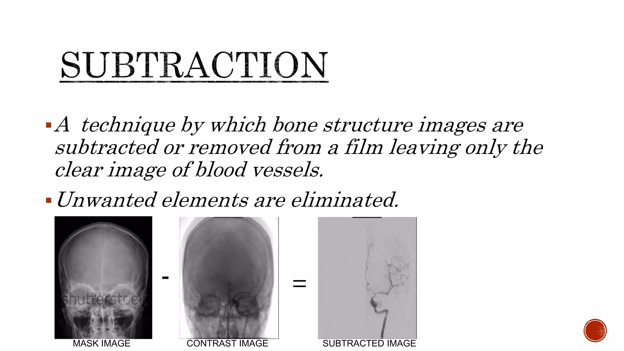 A technique by which bone structure images are
subtracted or removed from a film leaving only the
clear image of blood vessels.
Unwanted elements are eliminated.
- =
MASK IMAGE CONTRAST IMAGE SUBTRACTED IMAGE
 