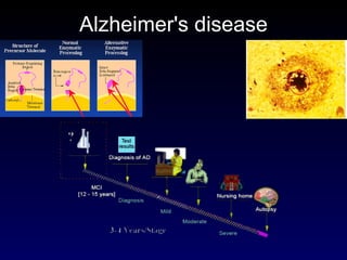 Alzheimer's disease 