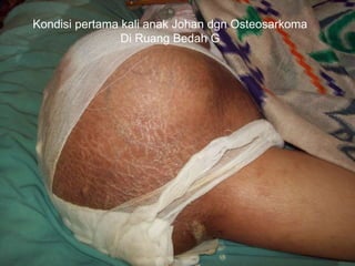 Kondisi pertama kali anak Johan dgn Osteosarkoma
Di Ruang Bedah G
 
