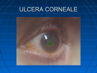 ULCERA CORNEALE

 