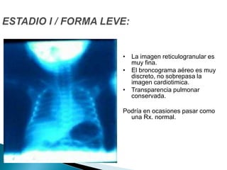 ESFINGOMIELINA				2%