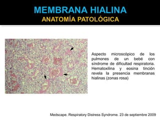 Aspecto microscópico de los
                        pulmones de un bebé con
                        síndrome de dificultad respiratoria.
                        Hematoxilina y eosina tinción
                        revela la presencia membranas
                        hialinas (zonas rosa)




Medscape. Respiratory Distress Syndrome. 23 de septiembre 2009
 