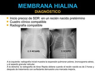    Inicio precoz de SDR en un recién nacido pretérmino
   Cuadro clínico compatible
   Radiografía compatible




A la izquierda: radiografía inicial muestra la expansión pulmonar pobres, broncograma aéreo,
y el aspecto granular reticular.
A la derecha: la radiografía de tórax Repita obtiene cuando el recién nacido es de 3 horas y
después de tratamiento con surfactante demuestra una marcada mejoría.
 