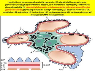 Localization of immune complexes in the glomerulus: (1) subepithelial humps, as in acute
glomerulonephritis; (2) epimembranous deposits, as in membranous nephropathy and Heymann
glomerulonephritis; (3) subendothelial deposits, as in lupus nephritis and membranoproliferative
glomerulonephritis; (4) mesangial deposits, as in IgA nephropathy; (5) basement membrane. EN,
endothelium; EP, epithelium; LD, lamina densa; LRE, lamina rara externa; LRI, lamina rara interna; MC,
mesangial cell; MM, mesangial matrix.
 