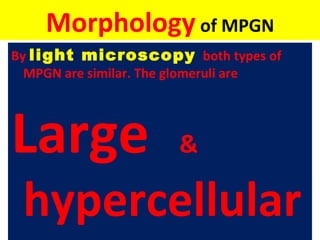 Morphology of MPGN
By light microscopy both types of
MPGN are similar. The glomeruli are
Large &
hypercellular
 
