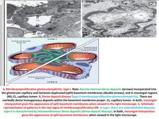 A, Membranoproliferative glomerulonephritis, type I. Note discrete electron-dense deposits (arrows) incorporated into
the glomerular capillary wall between duplicated (split) basement membranes (double arrows), and in mesangial regions
(M); CL, capillary lumen. B, Dense-deposit disease (type II membranoproliferative glomerulonephritis). There are
markedly dense homogeneous deposits within the basement membrane proper. CL, capillary lumen. In both, mesangial
interposition gives the appearance of split basement membranes when viewed in the light microscope. C, Schematic
representation of patterns in the two types of membranoproliferative GN. In type I there are subendothelial deposits;
type II is characterized by intramembranous dense deposits (dense-deposit disease). In both, mesangial interposition
gives the appearance of split basement membranes when viewed in the light microscope.
 