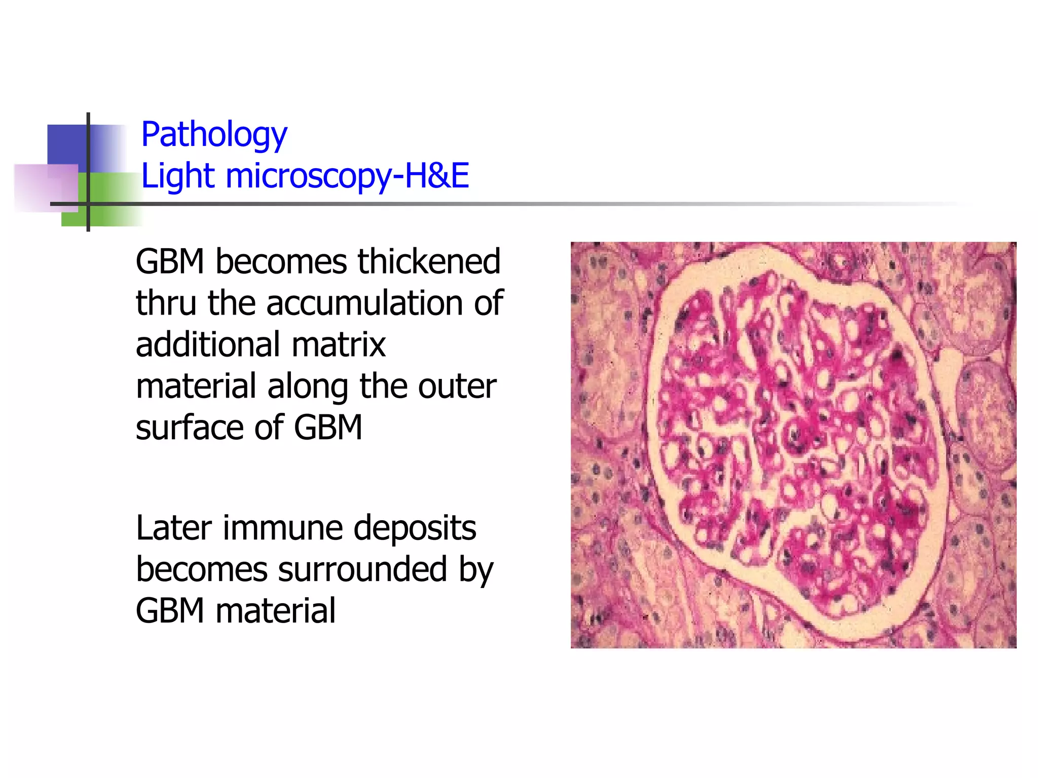 Pathology Light microscopy-H&E GBM becomes thickened thru the accumulation of additional matrix material along the outer surface of GBM  Later immune deposits becomes surrounded by GBM material 