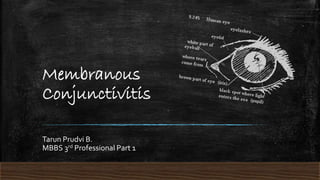 Membranous
Conjunctivitis
Tarun Prudvi B.
MBBS 3rd Professional Part 1
 