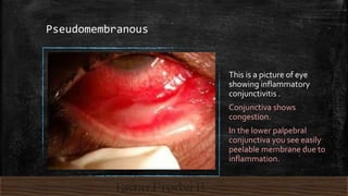 Pseudomembranous
This is a picture of eye
showing inflammatory
conjunctivitis .
Conjunctiva shows
congestion.
In the lower palpebral
conjunctiva you see easily
peelable membrane due to
inflammation.
 