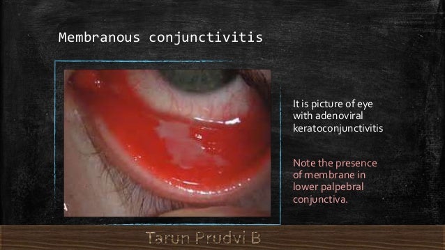 membranous conjunctivitis 11 638