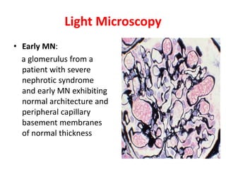 Light Microscopy
• Early MN:
a glomerulus from a
patient with severe
nephrotic syndrome
and early MN exhibiting
normal architecture and
peripheral capillary
basement membranes
of normal thickness
 