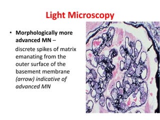 Light Microscopy
• Morphologically more
advanced MN –
discrete spikes of matrix
emanating from the
outer surface of the
basement membrane
(arrow) indicative of
advanced MN
 