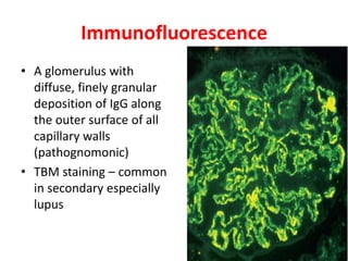 Immunofluorescence
• A glomerulus with
diffuse, finely granular
deposition of IgG along
the outer surface of all
capillary walls
(pathognomonic)
• TBM staining – common
in secondary especially
lupus
 