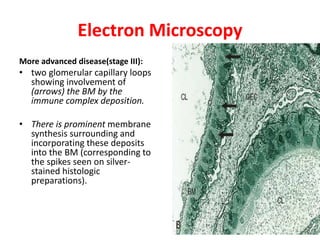 Electron Microscopy
More advanced disease(stage III):
• two glomerular capillary loops
showing involvement of
(arrows) the BM by the
immune complex deposition.
• There is prominent membrane
synthesis surrounding and
incorporating these deposits
into the BM (corresponding to
the spikes seen on silver-
stained histologic
preparations).
 