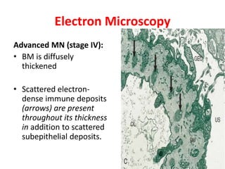 Electron Microscopy
Advanced MN (stage IV):
• BM is diffusely
thickened
• Scattered electron-
dense immune deposits
(arrows) are present
throughout its thickness
in addition to scattered
subepithelial deposits.
 