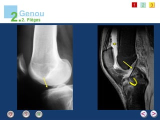 1 2 3
Genou
2.2. Pièges
 