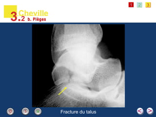 1 2 3
Fracture du talus
Cheville
3.2 b. Pièges
 
