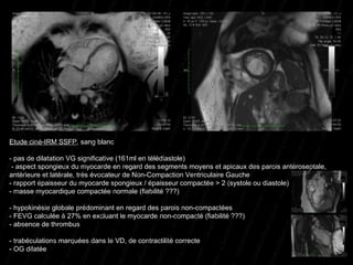 Etude ciné-IRM SSFP , sang blanc - pas de dilatation VG significative (161ml en télédiastole)  - aspect spongieux du myocarde en regard des segments moyens et apicaux des parois antéroseptale, antérieure et latérale, très évocateur de Non-Compaction Ventriculaire Gauche - rapport épaisseur du myocarde spongieux / épaisseur compactée > 2 (systole ou diastole) - masse myocardique compactée normale (fiabilité ???) - hypokinésie globale prédominant en regard des parois non-compactées - FEVG calculée à 27% en excluant le myocarde non-compacté (fiabilité ???) - absence de thrombus - trabéculations marquées dans le VD, de contractilité correcte - OG dilatée 