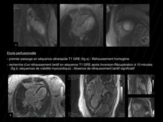 Etude perfusionnelle   - premier passage en séquence ultrarapide T1 GRE (fig a) : Réhaussement homogène - recherche d’un réhaussement tardif en séquence T1 GRE après Inversion-Récupération à 10 minutes    (fig b; séquences de viabilité myocardique) : Absence de réhaussement tardif significatif a b 