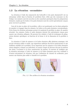 Chapitre 1. La rétention
1.3 La rétention –secondaire-
La rétention à l’aide des rainures(A) des boîtes(B) et des puits dentaires(C) est un
mécanisme utilisé dans la fixation de prothèses fixes, telles que des couronnes ou des
bridges. Les rainures sont des encoches ou des cannelures pratiquées dans les préparations
dentaires, tandis que les boîtes et les puits dentaires sont des cavités spécialement conçues
pour recevoir la prothèse.
Lors de la mise en place de la prothèse, celle-ci est positionnée sur les dents préparées
de manière à s’engager dans les rainures, les boîtes ou les puits dentaires correspondants.
Cette forme de rétention mécanique permet de maintenir la prothèse en place de manière
sécurisée. Les rainures, boîtes et puits dentaires doivent être précisément conçus pour
assurer une rétention adéquate. Ils peuvent être réalisés à l’aide de techniques de prépa-
ration dentaire spécifiques, en fonction de la forme et de la dimension de la prothèse à
fixer.
La rétention à l’aide de rainures et de boîtes dentaires offre plusieurs avantages, tels
qu’une rétention solide et stable, une répartition uniforme des forces masticatoires et une
meilleure stabilité de la prothèse. Il est important que les rainures et les boîtes dentaires
soient adaptées à chaque cas individuel, en tenant compte de facteurs tels que la position
des dents, l’occlusion et la force masticatoire du patient. Il convient de souligner que
la rétention mécanique à l’aide de rainures et de boîtes dentaires peut être combinée à
d’autres mécanismes de rétention, tels que l’utilisation de ciments de scellement, pour
assurer une fixation plus solide et durable de la prothèse.
Fig. 1.2 : Des artifices de rétention secondaires
4
 