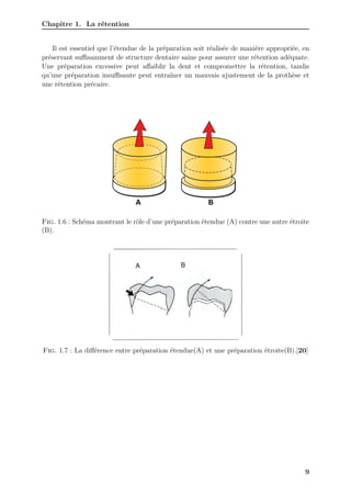 Chapitre 1. La rétention
Il est essentiel que l’étendue de la préparation soit réalisée de manière appropriée, en
préservant suﬀisamment de structure dentaire saine pour assurer une rétention adéquate.
Une préparation excessive peut affaiblir la dent et compromettre la rétention, tandis
qu’une préparation insuﬀisante peut entraîner un mauvais ajustement de la prothèse et
une rétention précaire.
Fig. 1.6 : Schéma montrant le rôle d’une préparation étendue (A) contre une autre étroite
(B).
Fig. 1.7 : La différence entre préparation étendue(A) et une préparation étroite(B).[20]
9
 