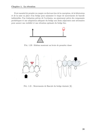 Chapitre 1. La rétention
Il est essentiel de prendre en compte ces facteurs lors de la conception, de la fabrication
et de la mise en place d’un bridge pour minimiser le risque de mouvements de bascule
indésirables. Une évaluation précise de l’occlusion, un ajustement précis des composants
prothétiques et une adaptation adéquate du bridge aux dents adjacentes sont nécessaires
pour assurer une stabilité et une rétention optimale du bridge fixe.
Fig. 1.20 : Schéma montrant un levier de première classe
Fig. 1.21 : Mouvements de Bascule du bridge dentaire [1].
26
 
