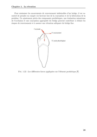 Chapitre 1. La rétention
Pour minimiser les mouvements de renversement indésirables d’un bridge, il est es-
sentiel de prendre en compte ces facteurs lors de la conception et de la fabrication de la
prothèse. Un ajustement précis des composants prothétiques, une évaluation minutieuse
de l’occlusion et une conception appropriée du bridge peuvent contribuer à réduire les
risques de renversement et à assurer une rétention adéquate du bridge fixe.
Fig. 1.22 : Les différentes forces appliquées sur l’élément prothétique.[7]
28
 