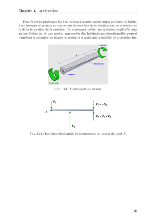 Chapitre 1. La rétention
Pour éviter les problèmes liés à la torsion et assurer une rétention adéquate du bridge,
il est essentiel de prendre en compte ces facteurs lors de la planification, de la conception
et de la fabrication de la prothèse. Un ajustement précis, une occlusion équilibrée, ainsi
qu’une évaluation et une gestion appropriées des habitudes parafonctionnelles peuvent
contribuer à minimiser les risques de torsion et à maintenir la stabilité de la prothèse fixe.
Fig. 1.23 : Mouvements de torsion.
Fig. 1.24 : Les forces résultantes les mouvements de torsion du point A.
30
 