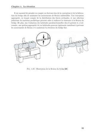 Chapitre 1. La rétention
Il est essentiel de prendre en compte ces facteurs lors de la conception et de la fabrica-
tion du bridge afin de minimiser les mouvements de flexion indésirables. Une conception
appropriée, en tenant compte de la distribution des forces occlusales, et une sélection
judicieuse du matériau prothétique peuvent aider à renforcer la résistance à la flexion du
bridge. De plus, une évaluation des habitudes parafonctionnelles chez le patient et, si né-
cessaire, une gestion appropriée de ces habitudes peuvent également contribuer à prévenir
les mouvements de flexion et à maintenir la rétention du bridge fixe.
Fig. 1.25 : Illustration de la flexion du bridge[20].
32
 