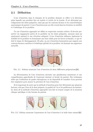 Chapitre 2. L’axe d’insertion
2.1 Définition
L’axe d’insertion dans le domaine de la prothèse dentaire se réfère à la direction
selon laquelle une prothèse fixe est insérée et retirée de la bouche. Il est déterminé par
l’alignement des dents préparées, ainsi que par les contours faciaux et les caractéristiques
anatomiques du patient. L’axe d’insertion joue un rôle crucial dans la rétention, la stabilité
et l’esthétique de la prothèse.
Un axe d’insertion approprié est défini en respectant certains critères. Il devrait per-
mettre un engagement précis de la prothèse sur les dents préparées, assurant ainsi un
ajustement optimal et une rétention adéquate. L’axe d’insertion influence également la
stabilité de la prothèse en fournissant une base solide pour les forces occlusales, ce qui ré-
duit le risque de désengagement. De plus, un axe d’insertion harmonieux par rapport aux
contours faciaux contribue à l’esthétique globale de la prothèse, lui donnant une apparence
naturelle.
Fig. 2.1 : Schéma montrant l’axe d’insertion de deux différentes préparations[21].
La détermination de l’axe d’insertion nécessite une planification minutieuse et une
compréhension approfondie de l’anatomie dentaire et faciale du patient. Des techniques
telles que l’utilisation de guides chirurgicaux ou de dispositifs de transfert d’axe peuvent
être employées pour assurer la précision de l’axe d’insertion.
Il est important de noter que la méthode d’insertion peut être déterminée par plusieurs
facteurs, tels que l’état de la dent préparée, la qualité de l’os et les préférences du dentiste.
Le choix de la méthode d’insertion appropriée sera fait en tenant compte de la situation
clinique spécifique et des besoins du patient.
Fig. 2.2 : Schéma montrant l’ajustement de l’axe d’insertion à la laide dune rainure[21].
37
 