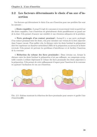 Chapitre 2. L’axe d’insertion
2.2 Les facteurs déterminants le choix d’un axe d’in-
sertion
Les facteurs qui déterminent le choix d’un axe d’insertion pour une prothèse fixe sont
les suivants :
• Dents cuspidées : Lorsqu’il s’agit de couronnes à recouvrement total ou partiel sur
des dents cuspidées, l’axe d’insertion est généralement choisi parallèlement au grand axe
de la dent. Cela permet d’assurer une stabilité et une rétention adéquates de la prothèse.
• Perte prolongée d’un contact proximal : Lorsqu’il y a une perte prolongée
d’un contact proximal entre les dents, cela peut entraîner une version de la dent adjacente
dans l’espace vacant. Pour pallier cela, la distance entre les dents bordant la préparation
doit être supérieure au diamètre mésiodistal (MD) de la préparation au niveau de la limite
cervicale. Cela permet de prévenir les problèmes d’interférence et de faciliter l’insertion
de la couronne.
• Réduction du volume des faces proximales : Dans certains cas, lorsque la
distance entre les dents bordant la préparation n’est pas suﬀisante, un compromis accep-
table consiste à réduire légèrement le volume des faces proximales des dents adjacentes à
la préparation. Cela permet de créer suﬀisamment d’espace pour l’insertion de la couronne
en ajustant l’inclinaison de son axe d’insertion.
Fig. 2.3 : Schéma montrant la réduction des faces proximales pour assurer et garder l’axe
d’insertion[21].
38
 