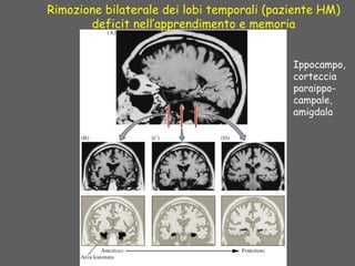 Rimozione bilaterale dei lobi temporali (paziente HM)
deficit nell’apprendimento e memoria
Ippocampo,
corteccia
paraippo-
campale,
amigdala
 