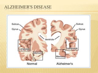 ALZHEIMER'S DISEASE
 