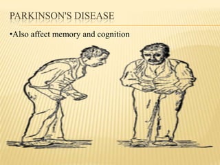 PARKINSON'S DISEASE
•Also affect memory and cognition
 