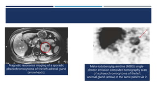 Magnetic resonance imaging of a sporadic
phaeochromocytoma of the left adrenal gland
(arrowheads).
Meta-iodobenzylguanidine (MIBG) single-
photon emission computed tomography scan
of a phaeochromocytoma of the left
adrenal gland (arrow) in the same patient as in
 