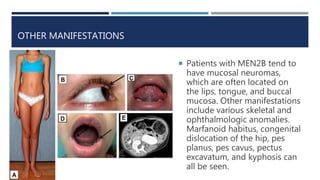 OTHER MANIFESTATIONS
 Patients with MEN2B tend to
have mucosal neuromas,
which are often located on
the lips, tongue, and buccal
mucosa. Other manifestations
include various skeletal and
ophthalmologic anomalies.
Marfanoid habitus, congenital
dislocation of the hip, pes
planus, pes cavus, pectus
excavatum, and kyphosis can
all be seen.
 