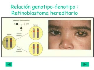 Relación genotipo-fenotipo :
Retinoblastoma hereditario
 