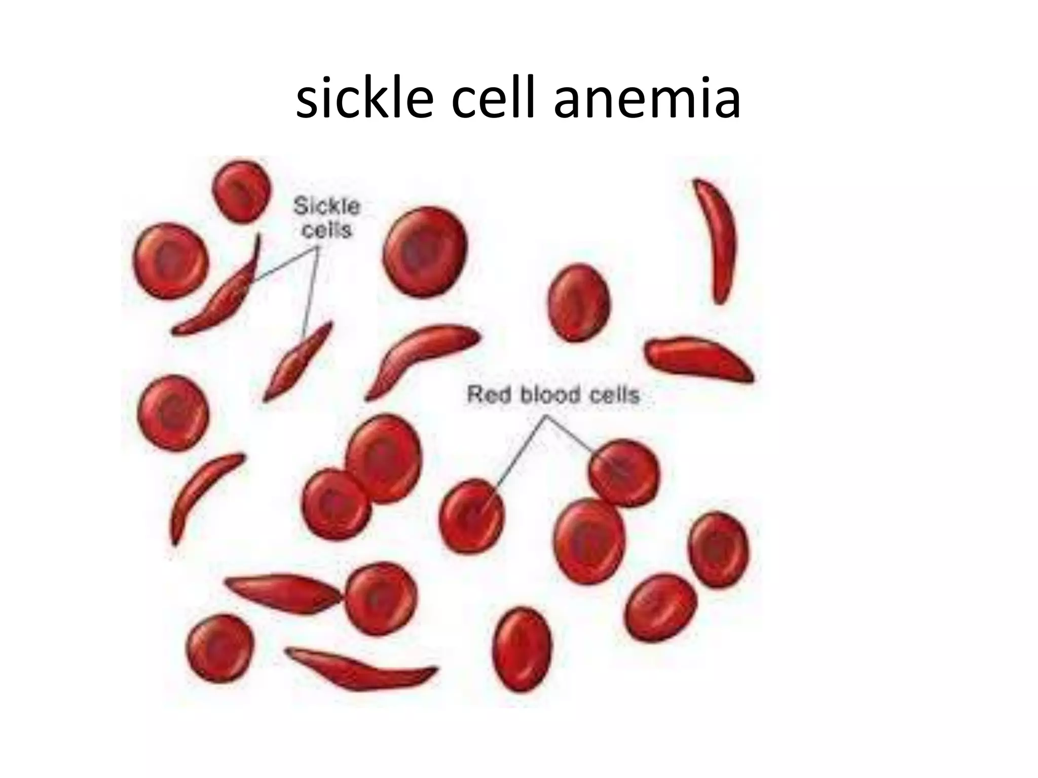 sickle cell anemia

 