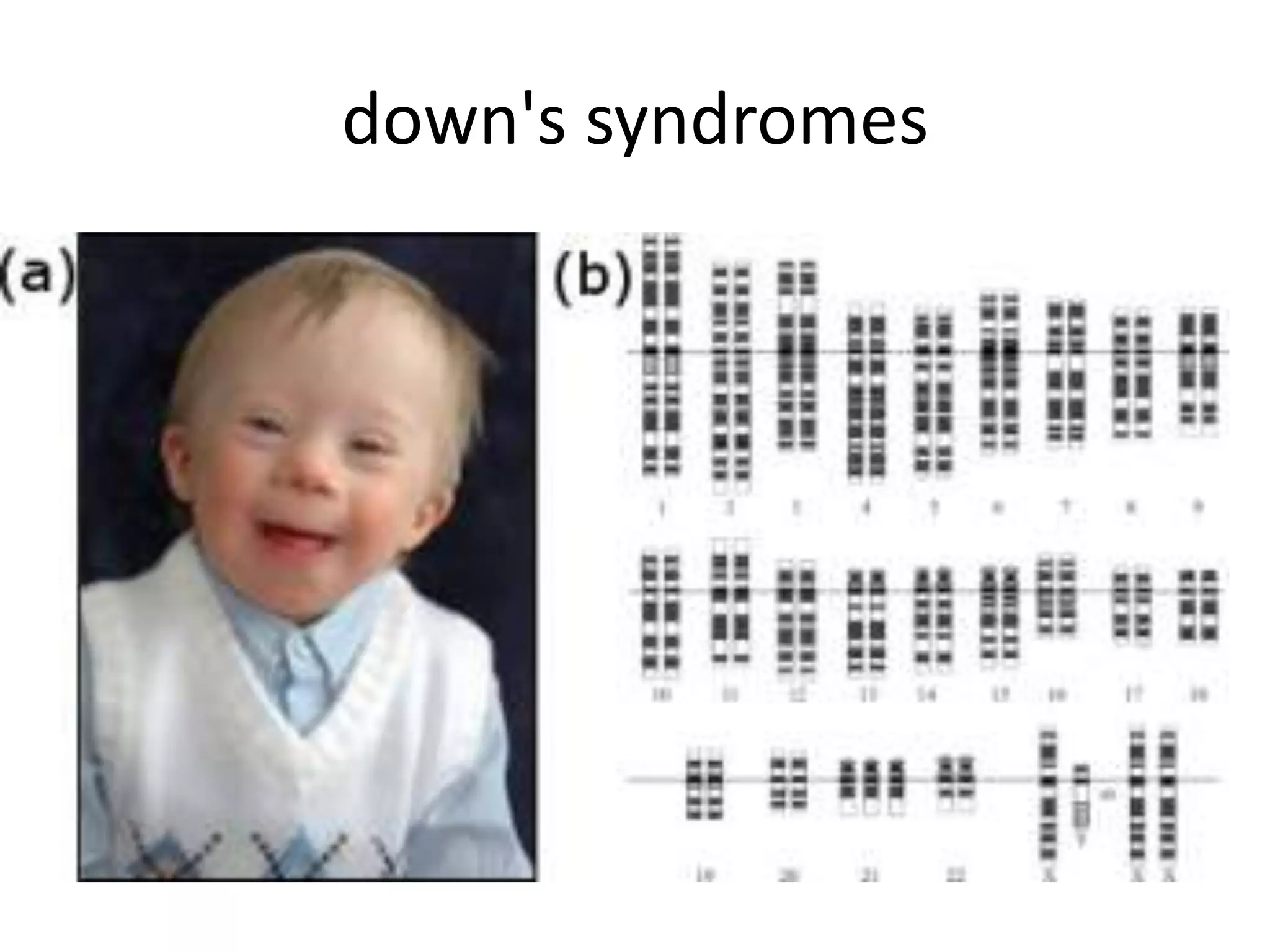 down's syndromes

 