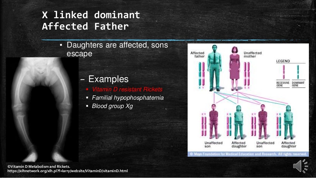 Mendelian (monegenic) disorders Hemophilia