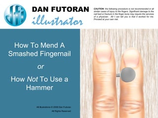 DAN FUTORAN How To Mend A Smashed Fingernail or How  Not  To Use a Hammer All illustrations © 2008 Dan Futoran All Rights Reserved CAUTION : the following procedure is not recommended in all similar cases of injury to the fingers. Significant damage to the nail bed or fracture in the finger bone may require the services of a physician.  All I can tell you is that it worked for me. Proceed at your own risk. 