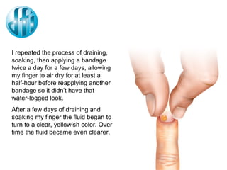I repeated the process of draining, soaking, then applying a bandage twice a day for a few days, allowing my finger to air dry for at least a half-hour before reapplying another bandage so it didn’t have that water-logged look. After a few days of draining and soaking my finger the fluid began to turn to a clear, yellowish color. Over time the fluid became even clearer. 