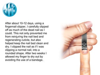 After about 10-12 days, using a fingernail clipper, I carefully clipped off as much of the dead nail as I could. This not only prevented me from reinjuring the nail bed and regenerating cuticle, but also helped keep the nail bed clean and dry. I clipped the nail as if I was clipping a normal nail, into a rounded shape. After two weeks I allowed my finger to dry out by avoiding the use of a bandage. 