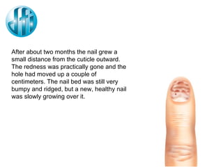 After about two months the nail grew a small distance from the cuticle outward. The redness was practically gone and the hole had moved up a couple of centimeters. The nail bed was still very bumpy and ridged, but a new, healthy nail was slowly growing over it. 