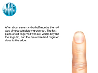 After about seven-and-a-half months the nail was almost completely grown out. The last piece of old fingernail was still visible beyond the fingertip, and the drain hole had migrated close to the edge. 