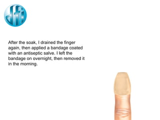 After the soak, I drained the finger again, then applied a bandage coated with an antiseptic salve. I left the bandage on overnight, then removed it in the morning.  