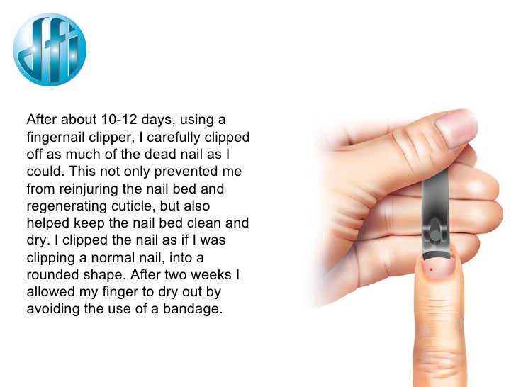 Mending A Smashed Finger